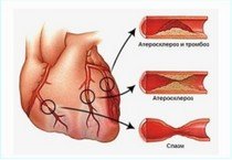 Ишемическая болезнь сердца