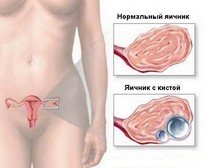 Женские болезни