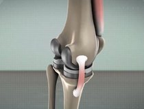 Показания к эндопротезированию коленного сустава 