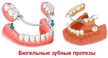 Современные бюгельные зубные протезы
