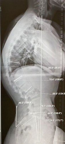 Рентгеновский снимок 20-летнего больного болезнью Шейерманна-Мау с кифозом в 70 градусов