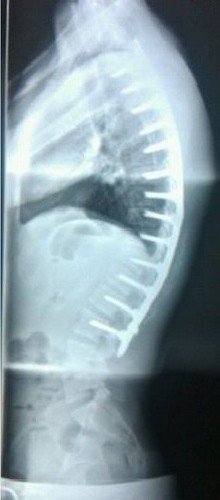 Рентгеновский снимок 22-летнего пациента после хирургического лечения болезни Шейерманна-Мау