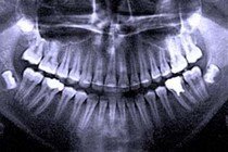 О рентгене зубов