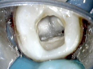 Зуб после экстирпации корневой пульпы