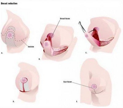 Редукционная маммопластика - операции по уменьшению груди