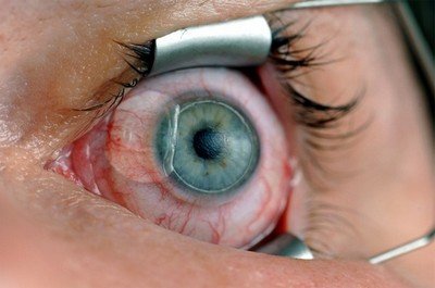 Период восстановления зрения после операций типа LASIK