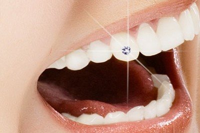 Какие бывают виды зубных украшений