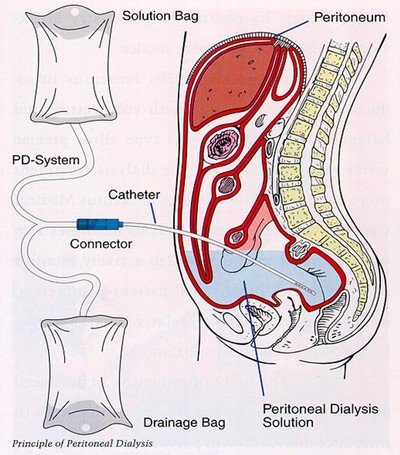 Принципиальная схема перитонеального диализа