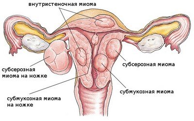 Причины и признаки миомы матки