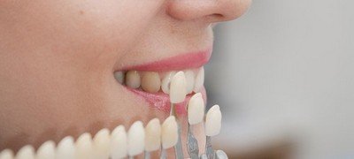 Индивидуальный подбор виниров для восстановления коронок зубов