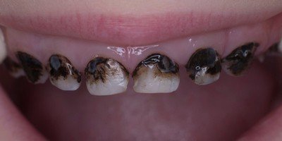 Использование препаратов «Saforide» и «Аргенат» в серебрении зубов у детей