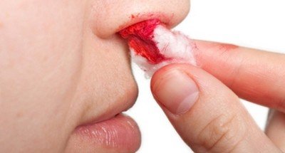Остановка кровотечения из носа при помощи ватного тампона