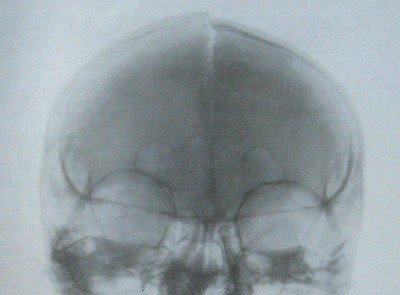 Перелом свода черепа на рентгеновским снимке
