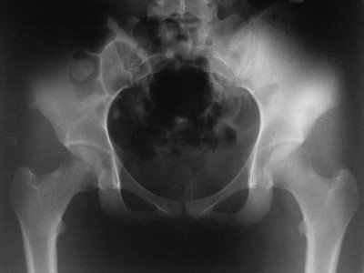 Перелом переднего тазового полукольца на рентгеновском снимке