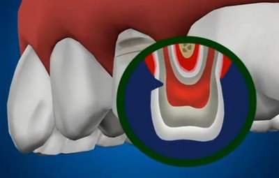 Как правильно лечить клиновидный дефект зуба незначительных размеров