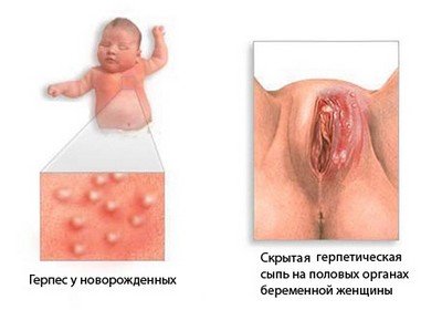 Клиника герпетической инфекции у взрослых, беременных и плода