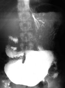 Стеноз начальной части двенадцатиперстной кишки на рентгеновских снимках
