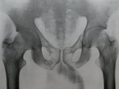 Рентгеновский снимок перелома переднего тазового полукольца в прямой проекции