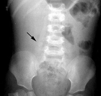 Рентгенодиагностика хронического аппендицита и ее история