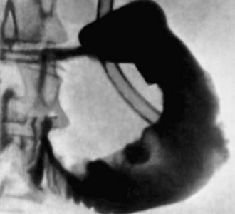 Рентгенологическая картина расширения двенадцатиперстной кишки
