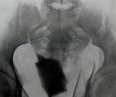 Оскольчатый перелом костей таза с образованием околопузырной гематомы на рентгеновском снимке