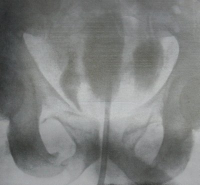 Рентгенограмма перелома костей таза с разрывом мочевого пузыря