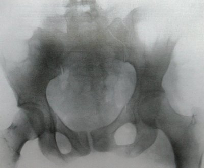 Рентгенодиагностика перелома костей таза с образованием околопузырной гематомы