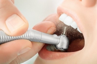 Основные способы пломбирования зубов в современной стоматологии