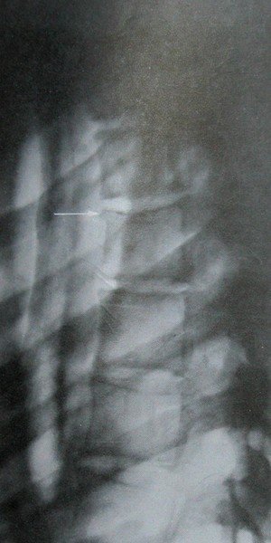 Рентгеновский снимок отлома края 4 грудного позвонка в боковой проекции