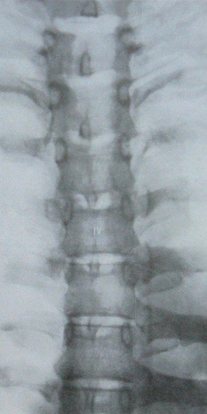 Рентгеновский снимок отлома края 4 грудного позвонка в задней проекции