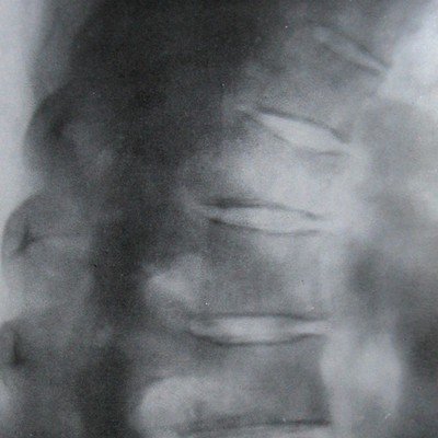Рентгеновский снимок перелома 4 и 5 грудных позвонков в боковой проекции