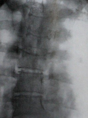 Рентгеновский снимок перелома 4 и 5 грудных позвонков в задней проекции