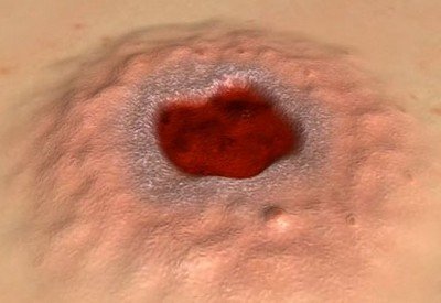 Мягкий шанкр - венерическое заболевание, вызываемое Hämophilus ducreyi