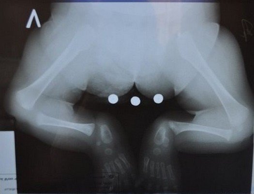Отсутствие большеберцовой кости на рентгенограмме