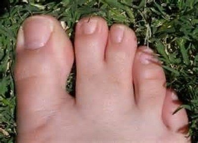 Синдактилия пальцев ног