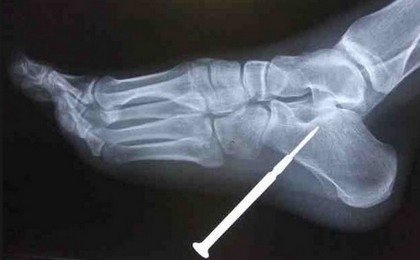 Рентгенодиагностика ранений костей колющими предметами