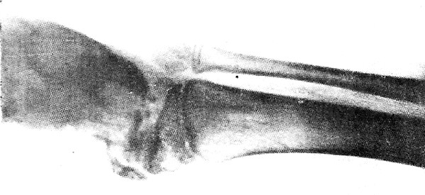 Рентгенограмма гемимелической формы эпифизарной дисплазии (фото)