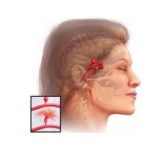 Основные методы современной диагностики аневризм сосудов головного мозга