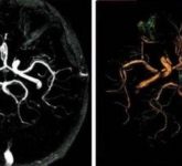 Что такое МРТ-исследование с контрастированием?