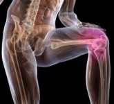 О деформирующем остеоартрозе коленного сустава