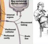 Преимущества и недостатки перитонеального диализа
