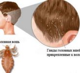 Педикулез - причины и лечение