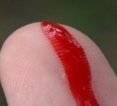 ДВС-синдром - cиндром диссеминированного внутрисосудистого свертывания крови