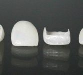 Облицовка зубов винирами или эмалевой заготовкой в восстановлении коронок зубов