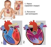 Правостороннее расположение сердца носит название «декстрокардия»