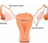 Эндометриоз: симптомы, лечение, диагностика