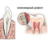 Пример клиновидного дефекта зуба