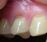 Какая существует классификация клиновидных дефектов зубов?