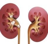 Что делать, чтобы не было камней в почках?