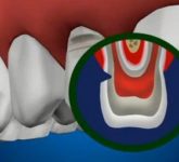 Как правильно лечить клиновидный дефект зуба незначительных размеров
